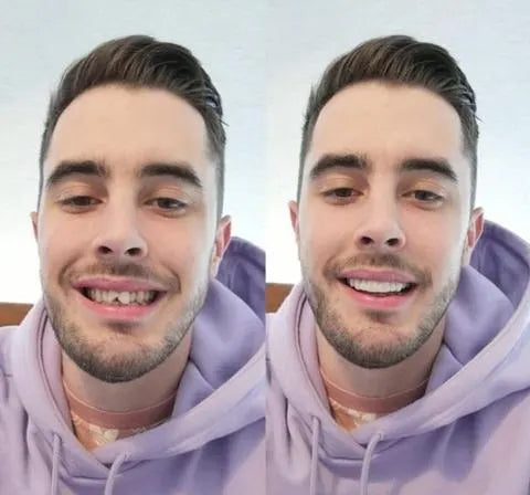 Transformeer uw glimlach met deze cosmetische veneers voor boven- en onderkaak. Meer zelfvertrouwen.