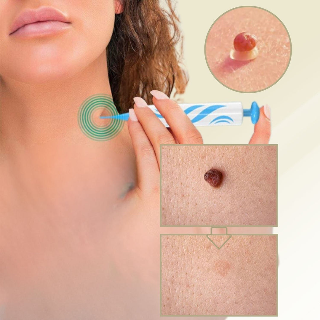 Cosmetische wratten- en moedervlekkenverwijderaar voor pijnloos thuisgebruik. Voor een egale huid.