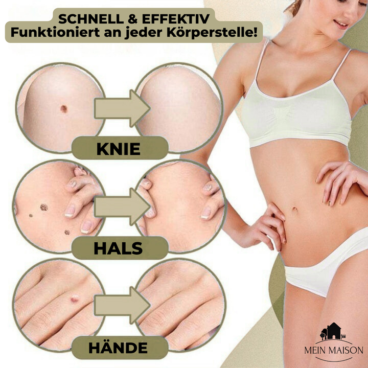 Thuis wratten en moedervlekken pijnloos verwijderen met deze cosmetische huidverzorging.