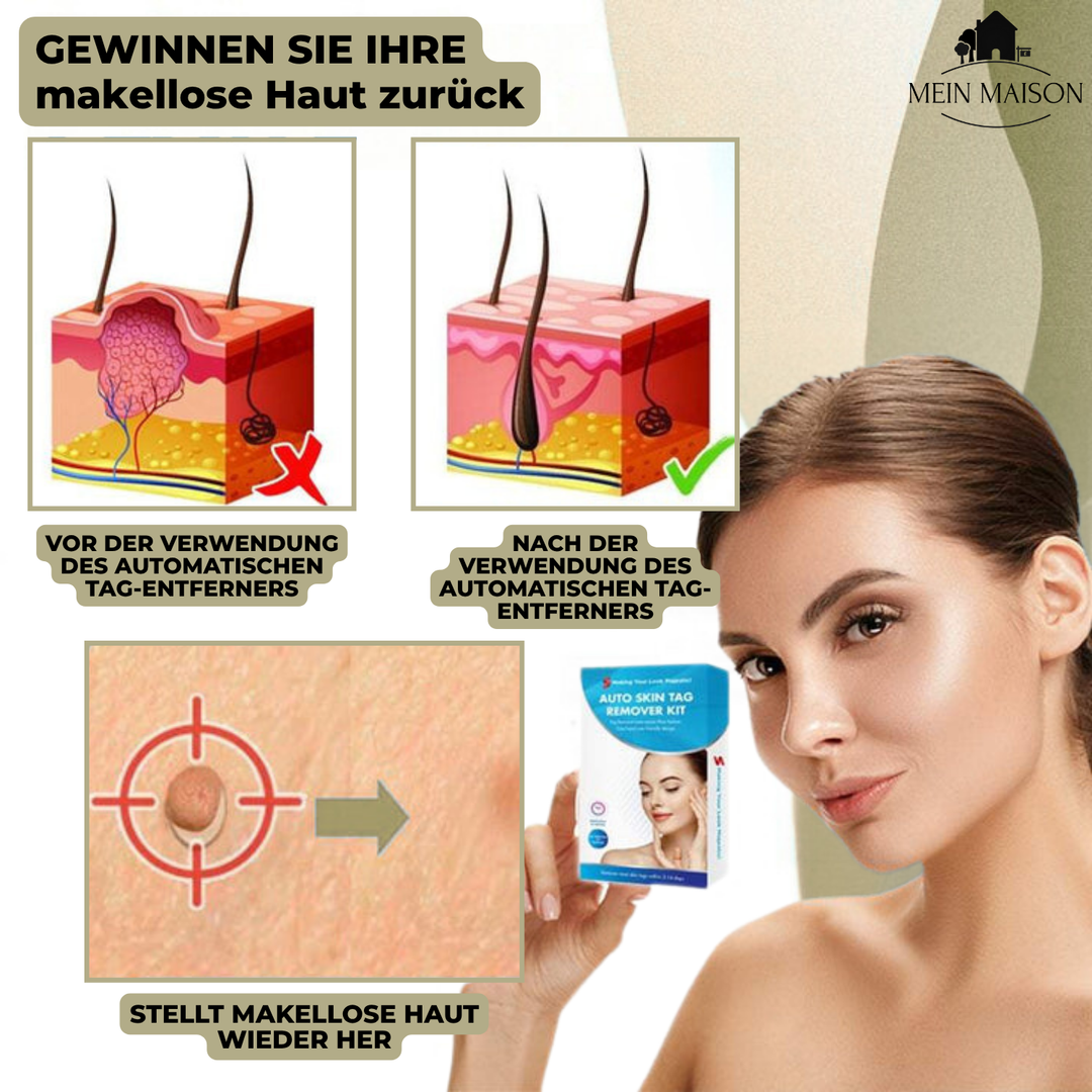 Krijg een egale huid met deze pijnloze cosmetische wratten- en moedervlekken verwijderaar.