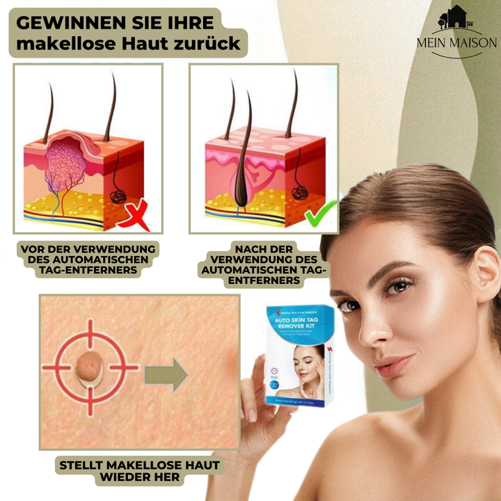 Krijg een egale huid met deze pijnloze cosmetische wratten- en moedervlekken verwijderaar.
