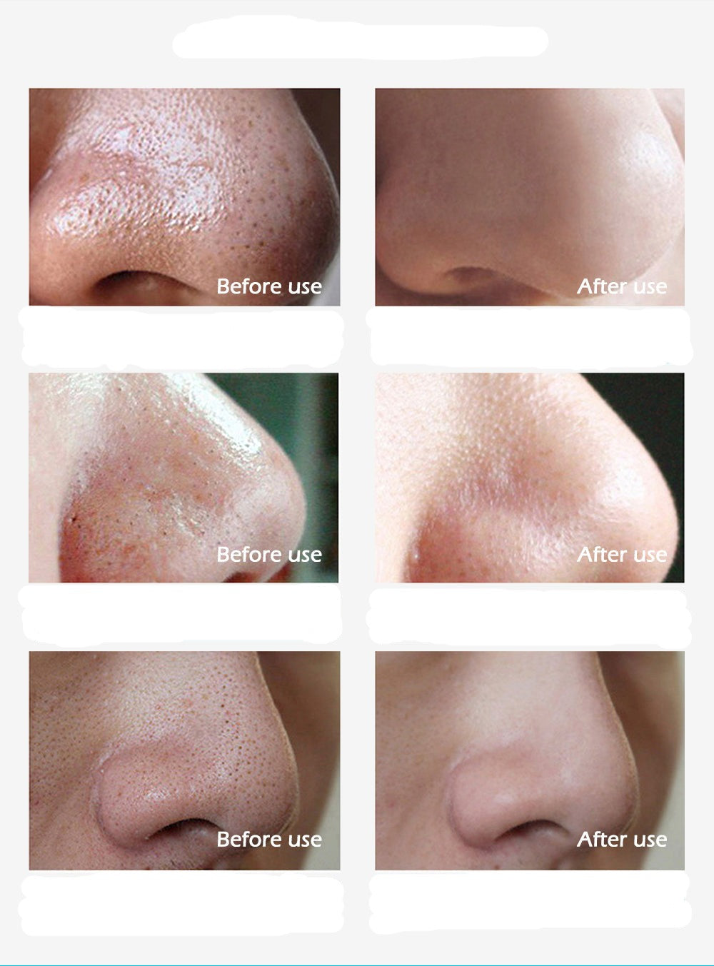 Resultaat: schone, gladdere huid na gebruik van ClearSkin™ mee-eter verwijderaar masker. Effectieve huidverzorging.