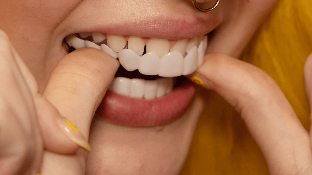 Stralende glimlach met Snap-On Tanden Veneers; verhoogt zelfvertrouwen en geeft een direct perfect cosmetisch gebit.