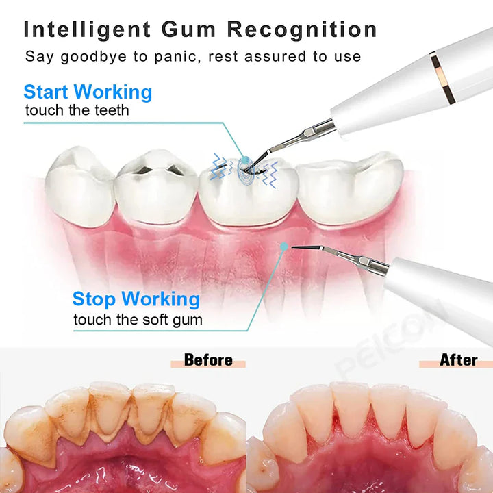Ultrasone tandreiniger voor gezondere mondhygiëne en wittere glimlach; effectief tegen plaque en tandsteen.