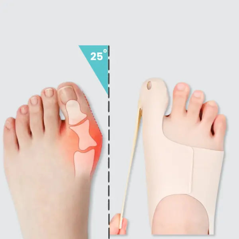 Discrete hallux valgus teenmouw voor comfort en correctie, ideaal voor dagelijks gebruik onder schoenen.