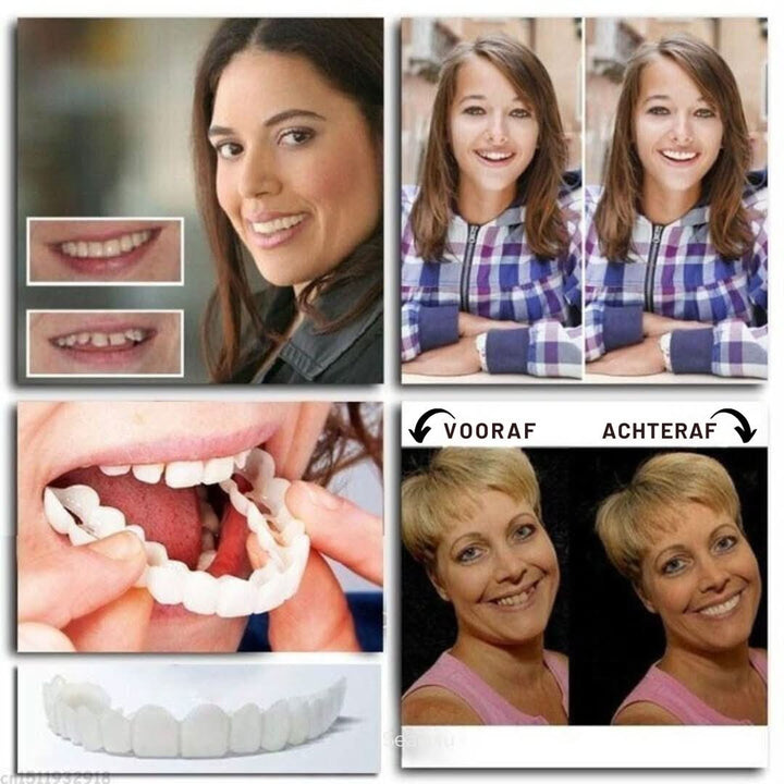 Praktische snap-on facings voor snelle gebitsverzorging en een zelfverzekerde glimlach. Gemakkelijk herbruikbaar.