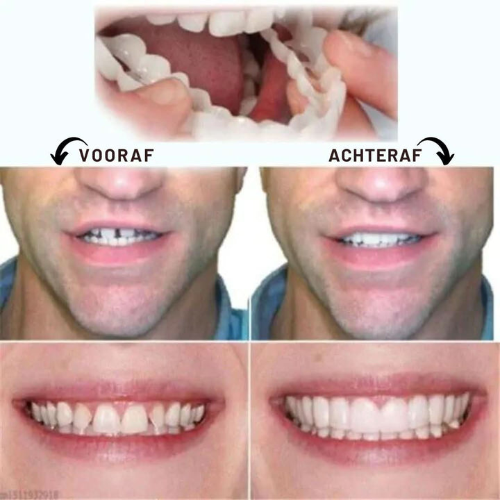 Set verstelbare cosmetische tanden van siliconen; tijdelijke facings voor een complete glimlach make-over.